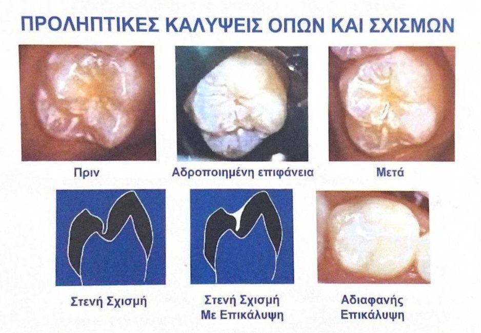 Προληπτικές καλύψεις οπών και σχισμών